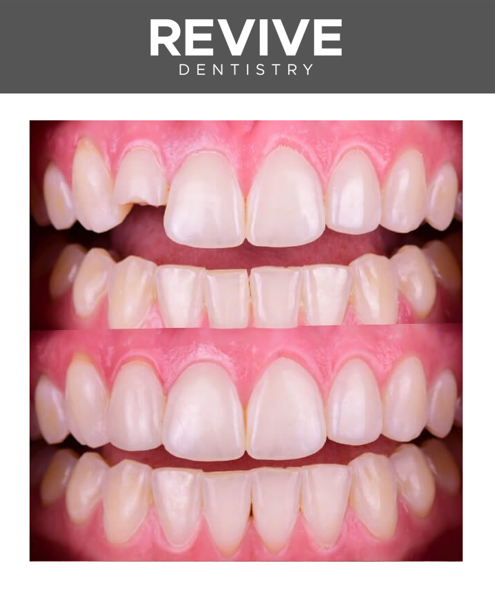 Before and after comparison photos of a Revive Dental patient.