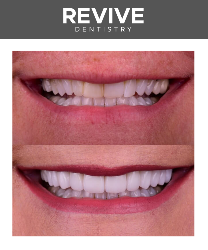 Before and after comparison photos of a Revive Dental patient.