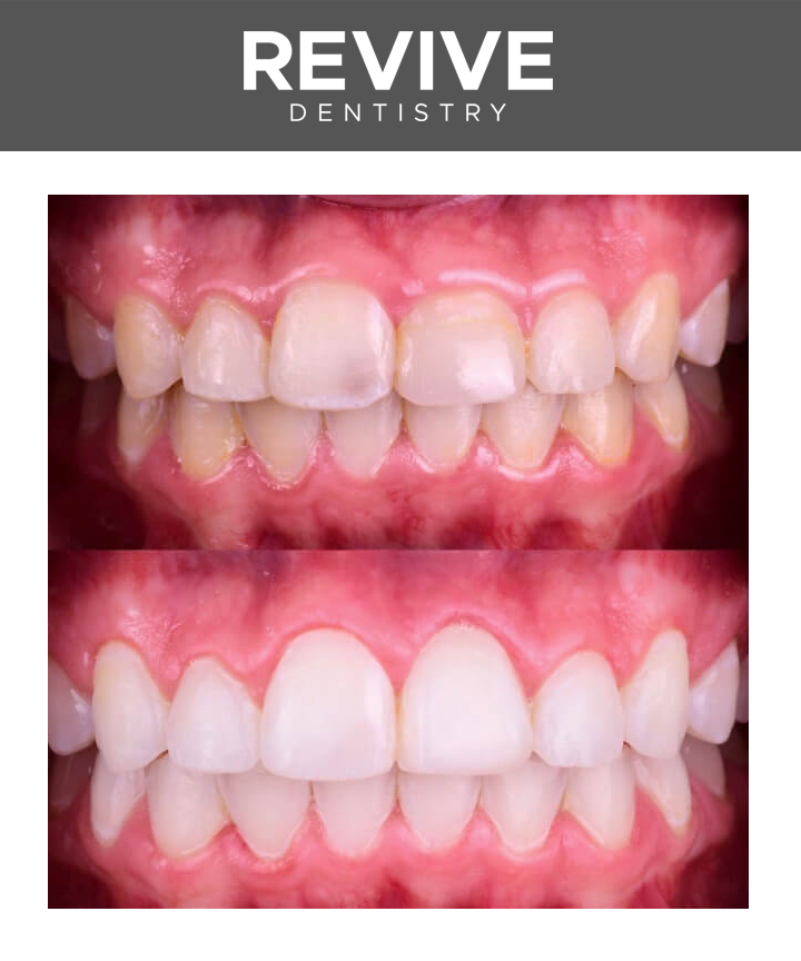 Before and after comparison photos of a Revive Dental patient.