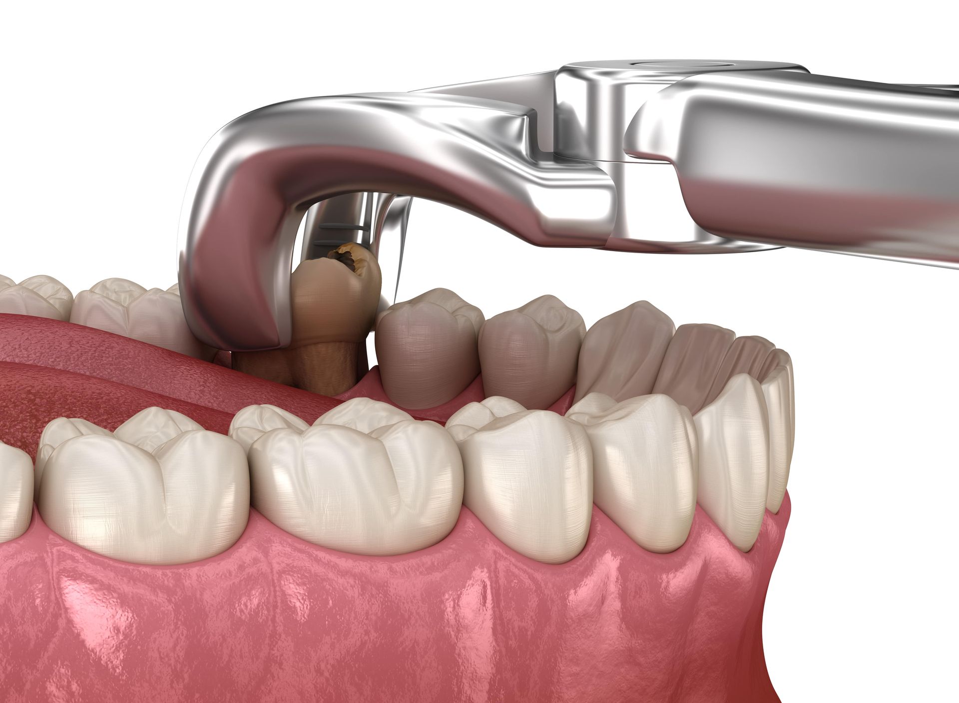 Digital illustration of a tooth extraction.