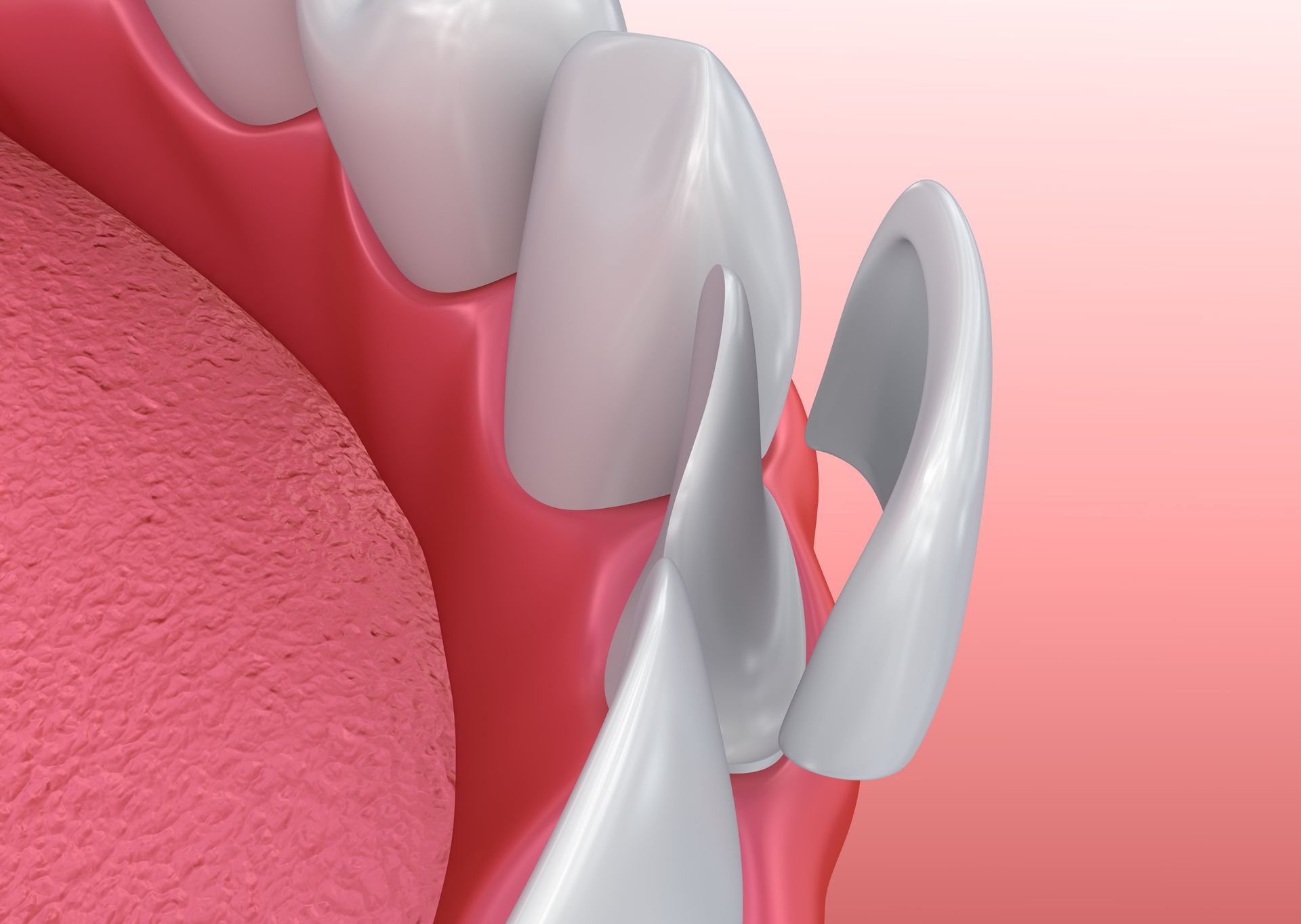 Digital illustration of dental veneers.