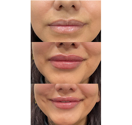 Injectables Lips Procedure