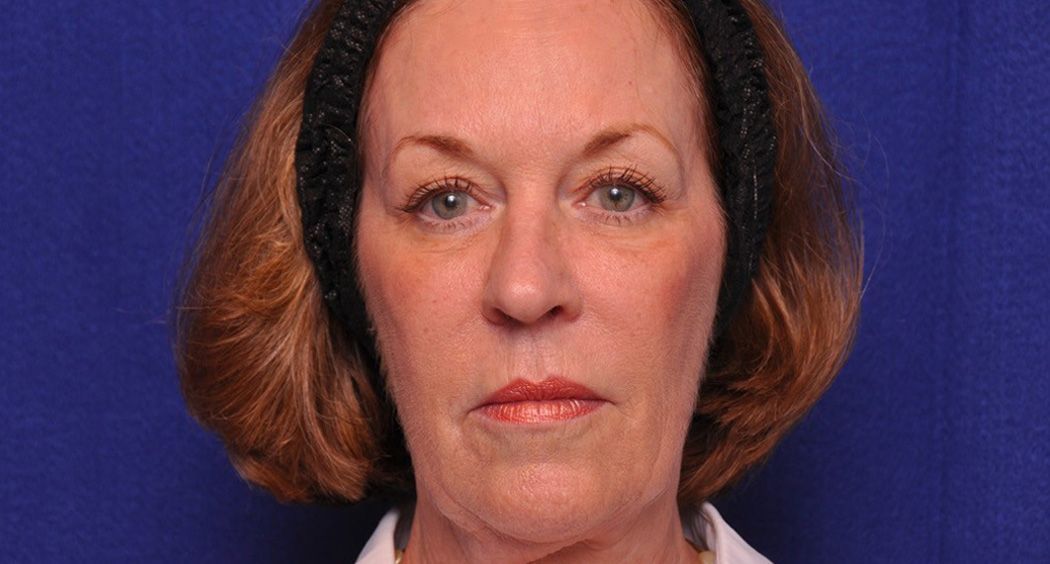 face of mature female after Renuva treatment