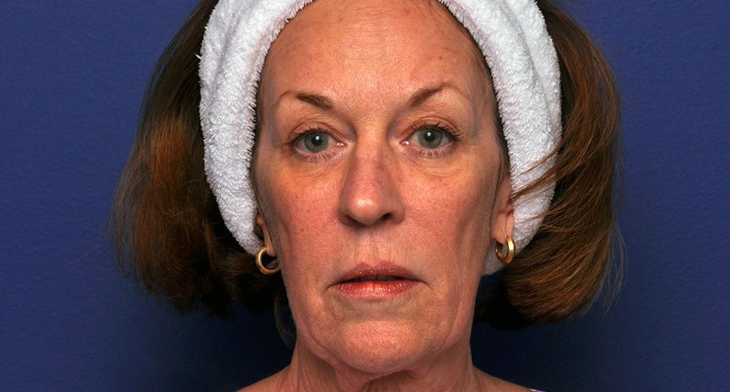 face of mature female before Renuva treatment