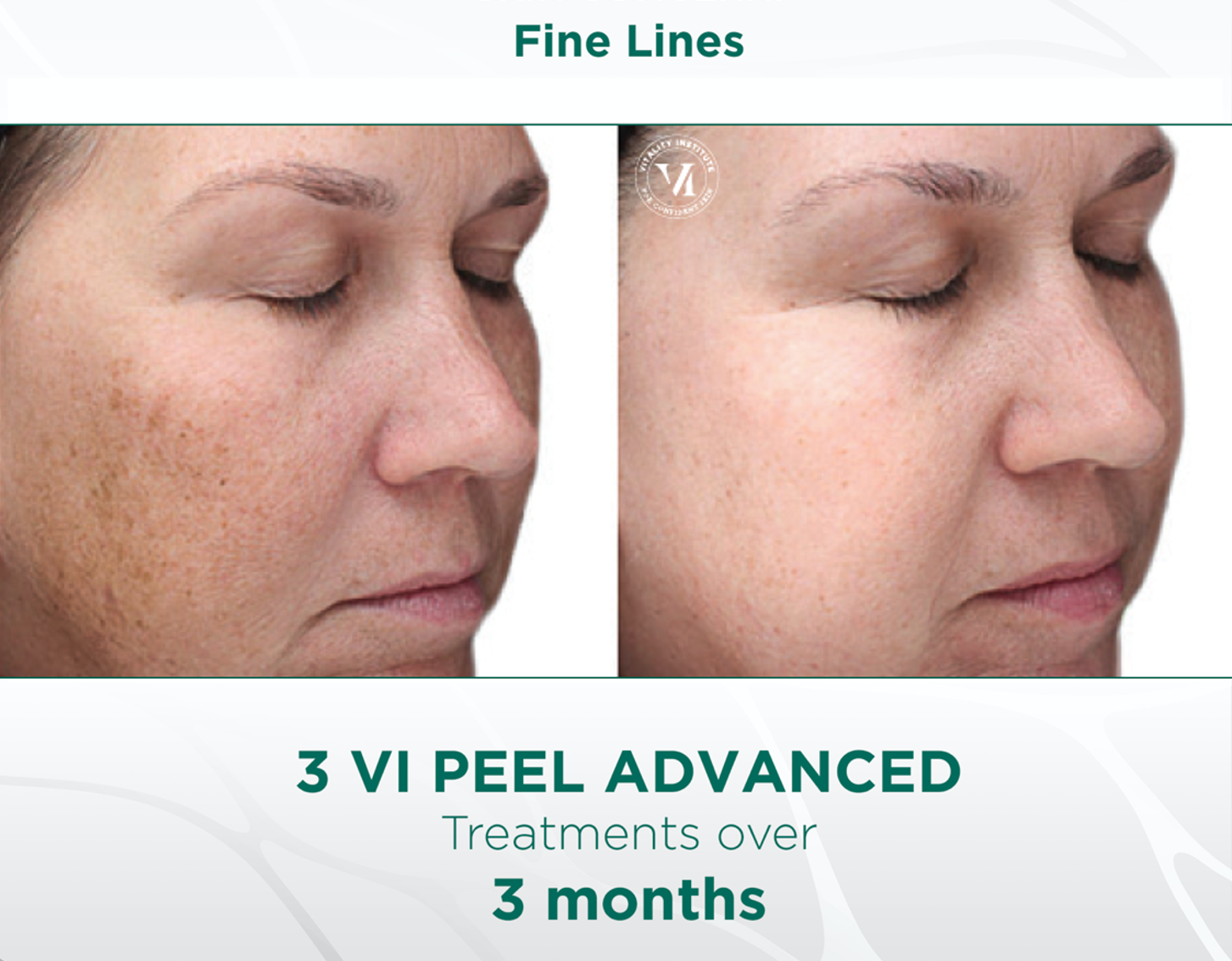 woman's face before and after VI Peel chemical peel treatment