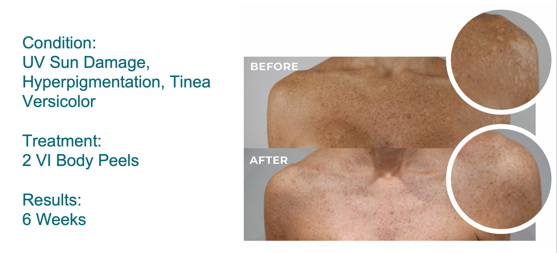 woman's chest before and after VI Peel chemical peel treatment