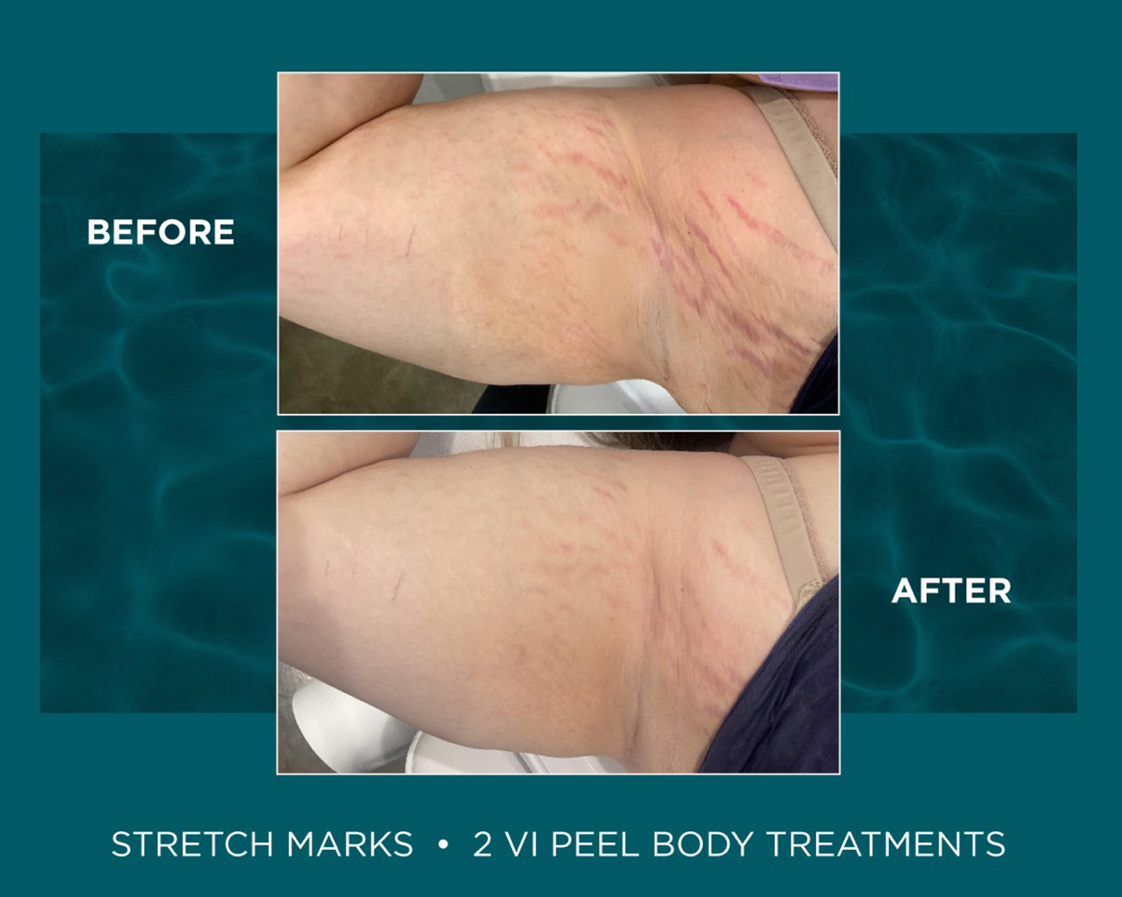 woman's bicep and underarm area before and after VI Peel chemical peel treatment for scarring and stretch marks