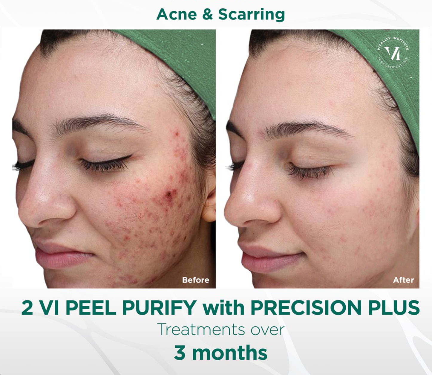 woman's face before and after VI Peel chemical peel treatment