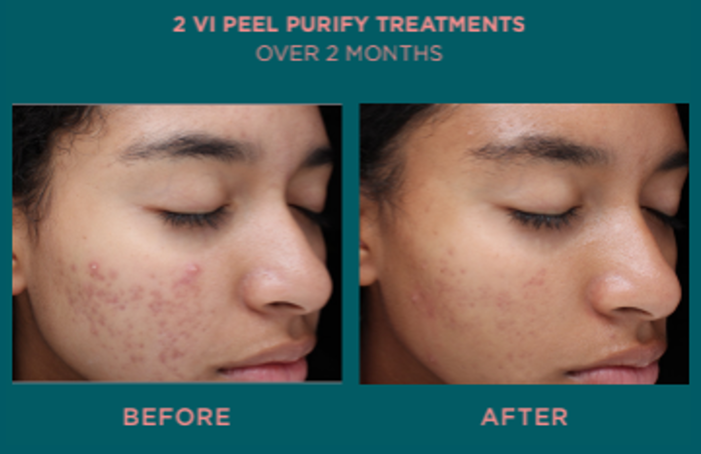 woman's face before and after VI Peel chemical peel treatment