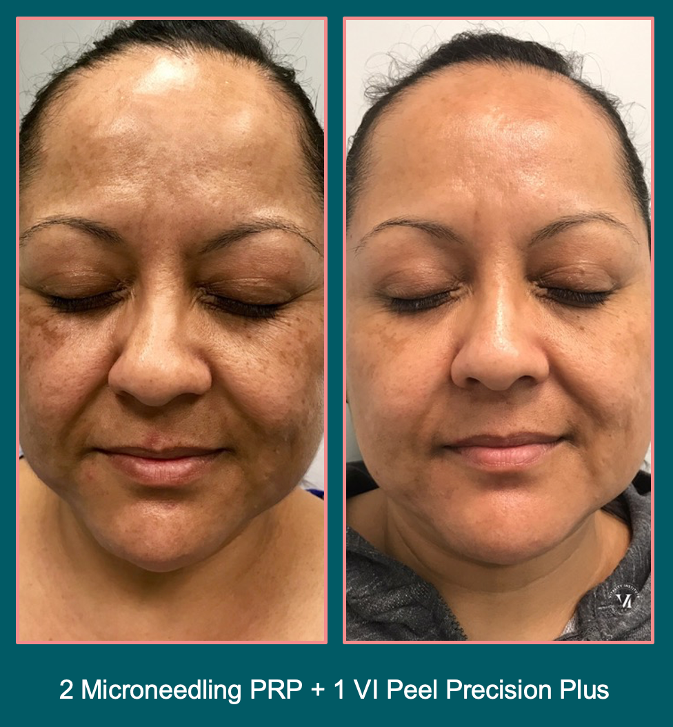 woman's face before and after VI Peel chemical peel treatment