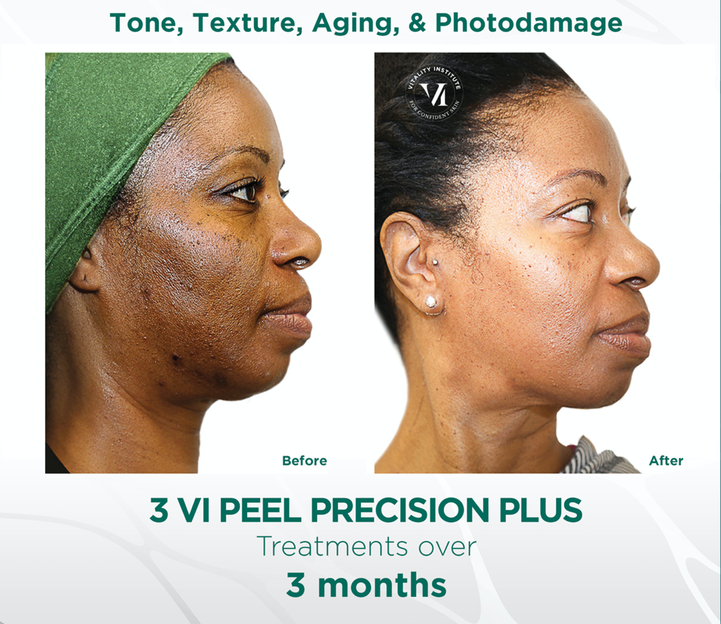 woman's face before and after VI Peel chemical peel treatment