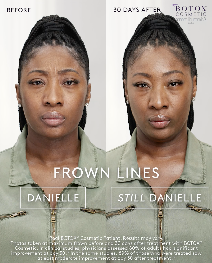 a woman's face before and after Botox treatment
