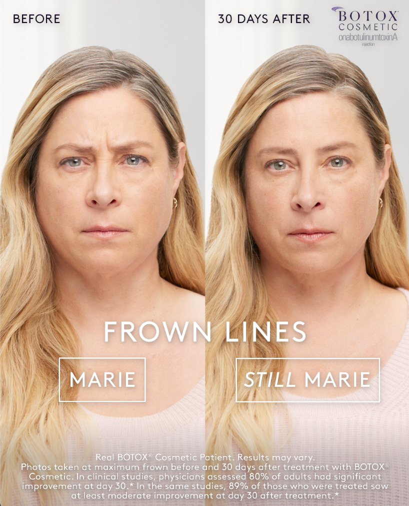 a woman's face before and after Botox treatment