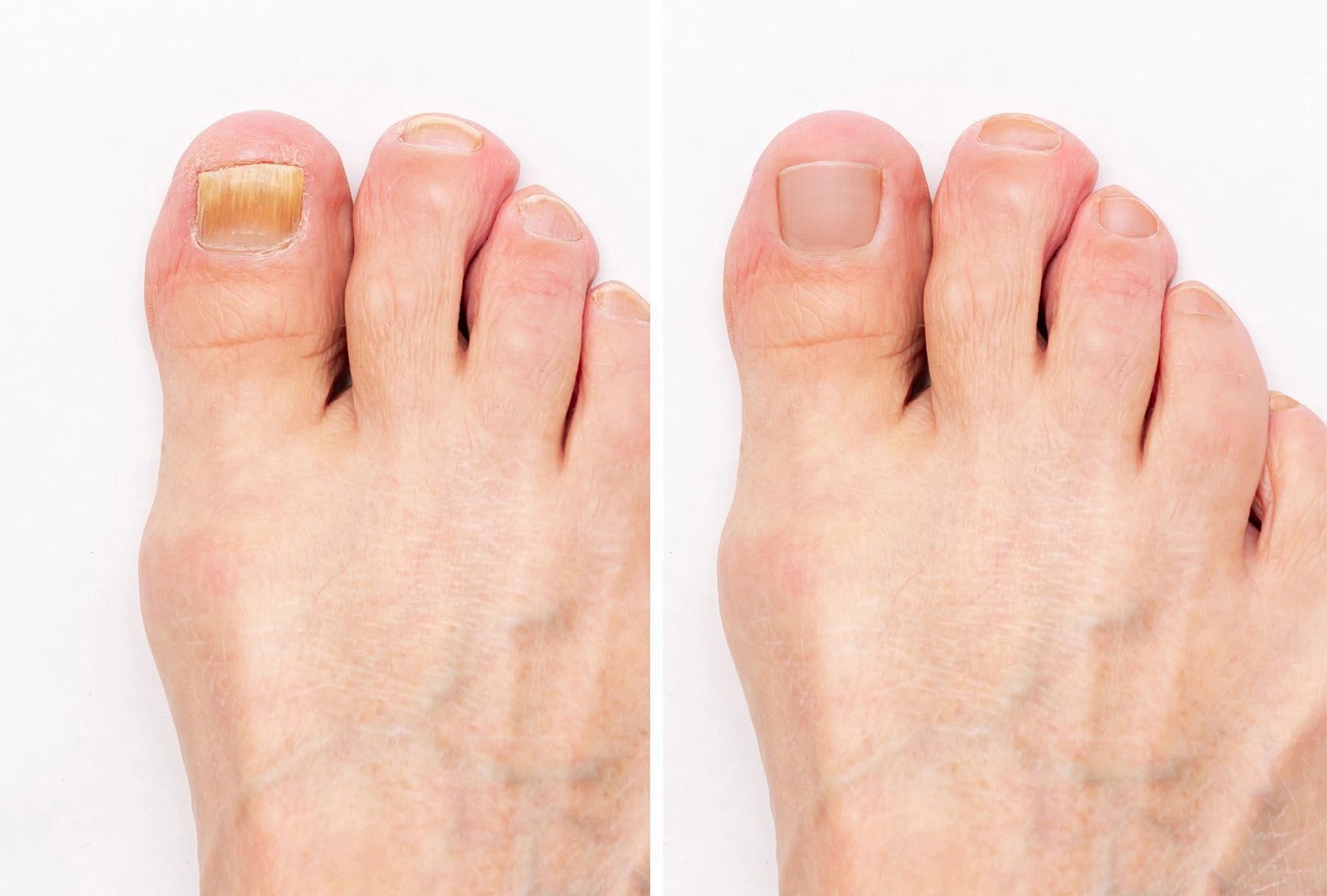 A before and after picture of a person's toenails after fungus treatment