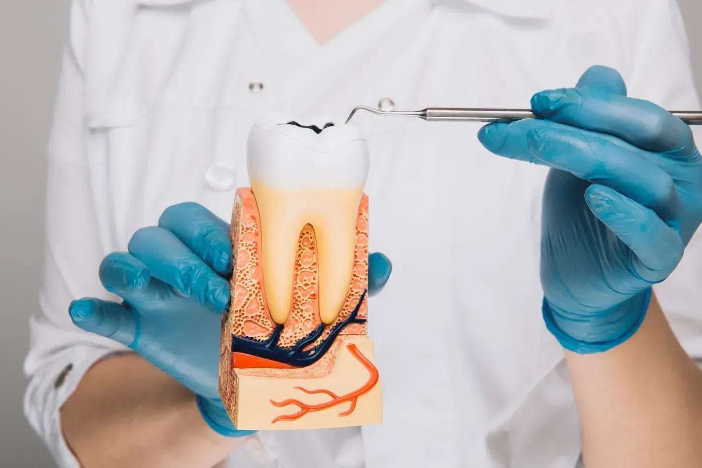 A person in a white coat and blue gloves holds a dental model of a tooth with decay, touching it with a metal explorer.