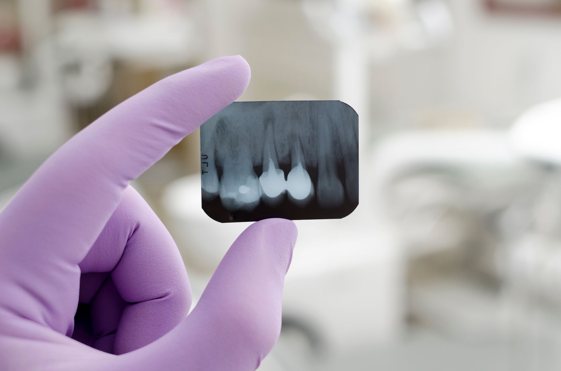 Close-up of a dental X-ray held by a gloved hand, showing tooth roots.