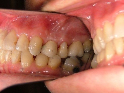 dentatura