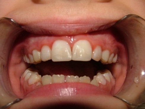 faccette dentali
