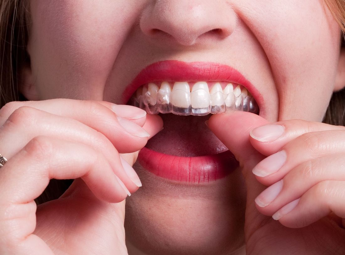 Invisalign