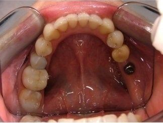 arco denti superiori