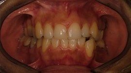 interspazi dentali