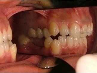 denti sovrapposti