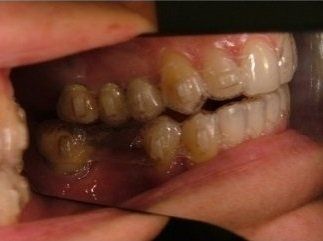 denti storti
