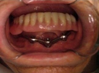 impianto dentale