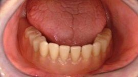 dentiera