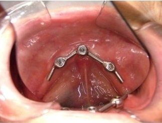 impianto per dentiera