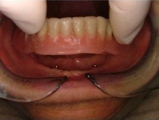 inserimento dentiera