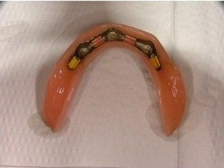 calco per dentiera