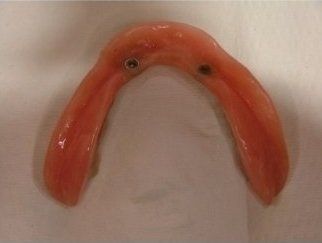 dentiera
