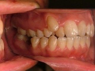 denti affollati