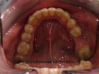 denti da allineare