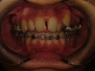 apparecchio dentale