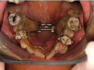impianto dentale