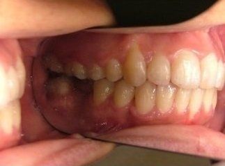 denti disallineati