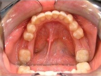 denti mancanti