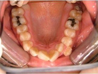 denti storti