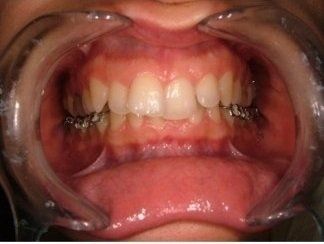 denti storti