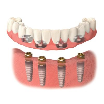 A Person Is Holding A Denture With Screws On It — Harvey Smiles Denture Clinic In Burleigh Heads, QLD