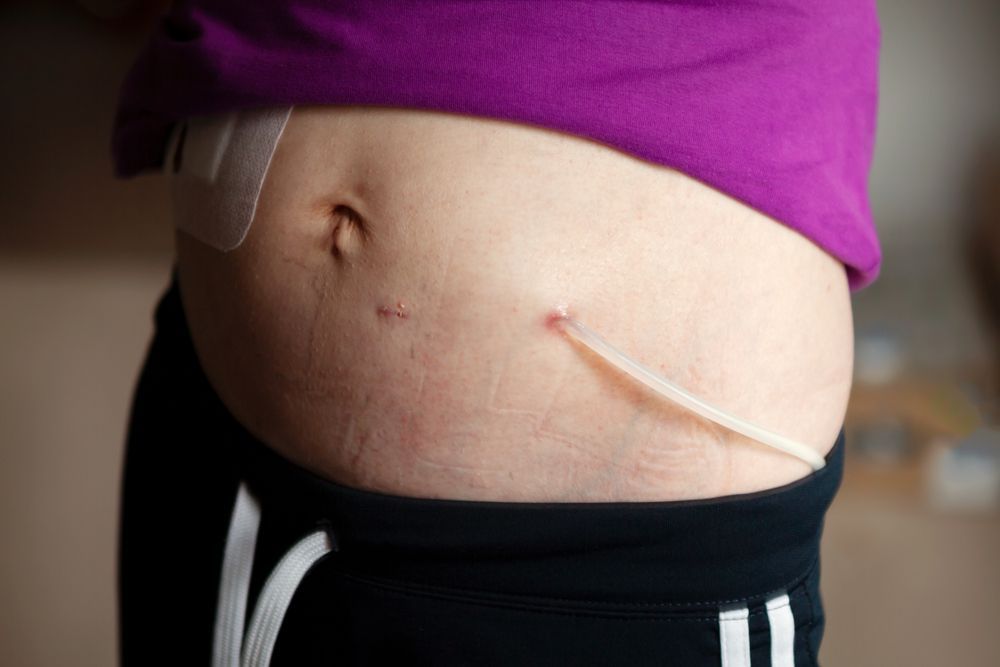 A close up of a person 's stomach with a tube in it.