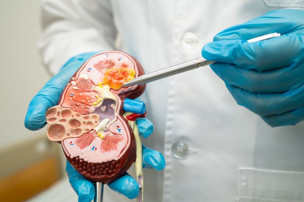 A doctor is holding a model of a kidney with a needle in it.