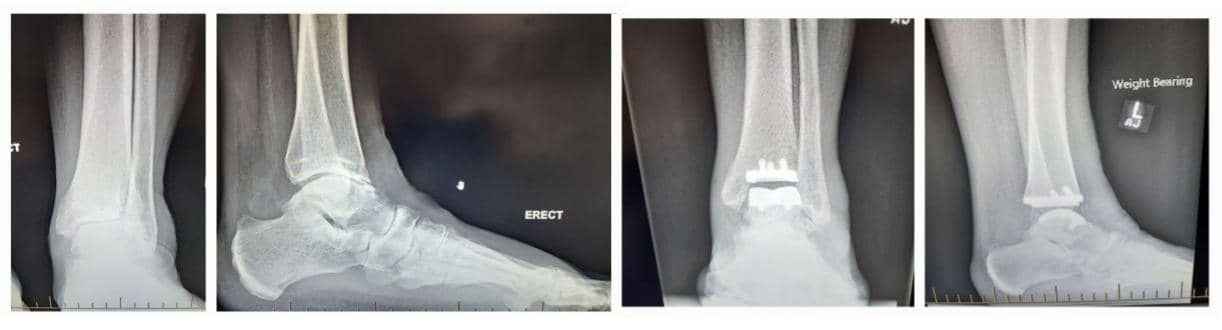 ADVANCED ANKLE SURGERY