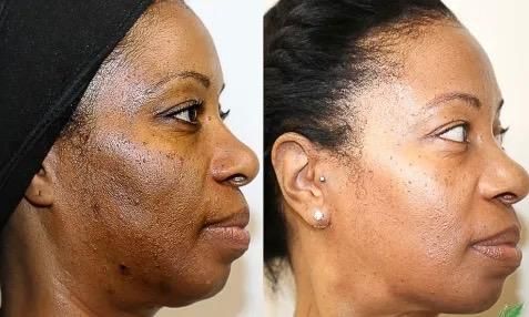 Comparison of a person's face before and after skin treatment, showing reduced dark spots and improved skin tone.