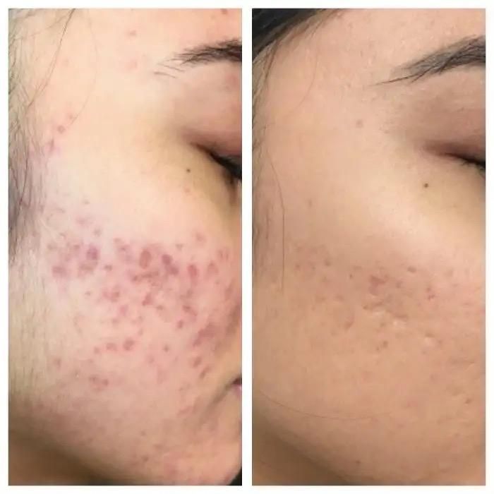 Before and after photos showing skin with acne improved after treatment.