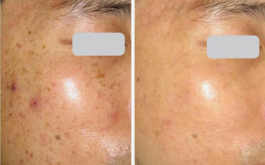 Before and after comparison of a person's facial skin. Left shows spots and blemishes, right shows clearer skin.
