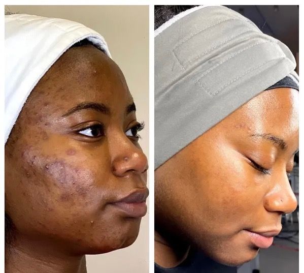 Side-by-side photos of a person with facial acne before and after treatment, showing significant improvement.
