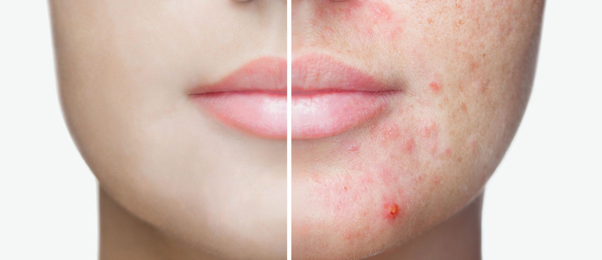 Side-by-side comparison of skin. One side appears smooth, the other has acne.